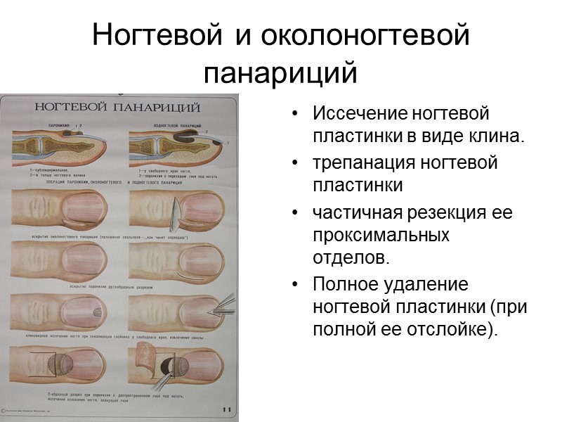 Ногтевой и околоногтевой панариций Иссечение ногтевой пластинки в виде клина. трепанация ногтевой пластинки 